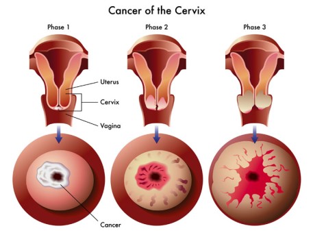 High Dose Rate Brachytherapy for Cervical Cancer by OrangeCountySurgeons